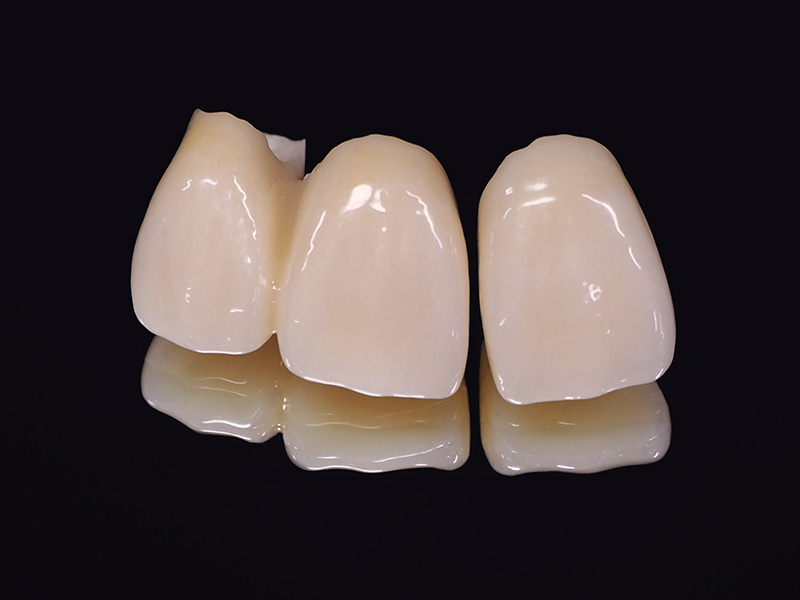 自然な白さと透明感 ― セラミッククラウン