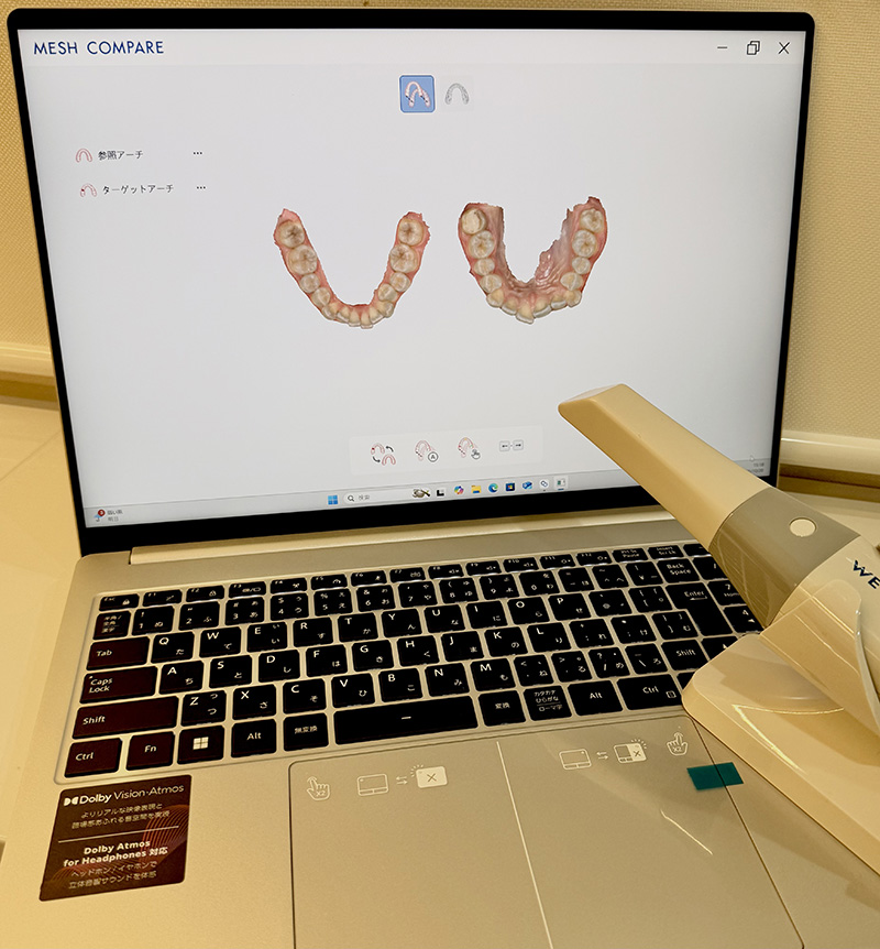 歯をほとんど削らない審美治療 ― ラミネートべニア