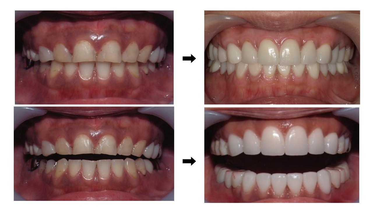 咬合挙上測定・審美治療