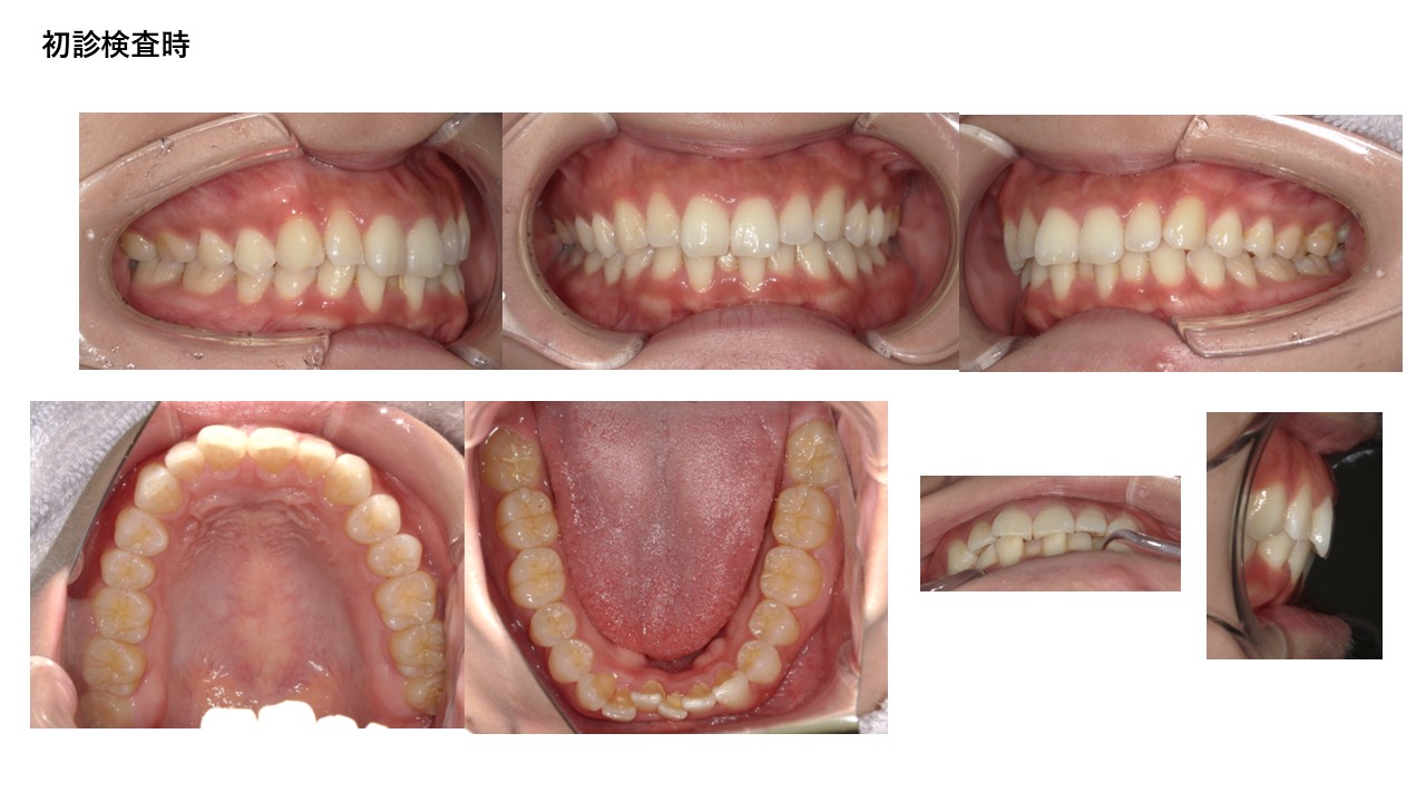 マウスピース矯正症例初診時