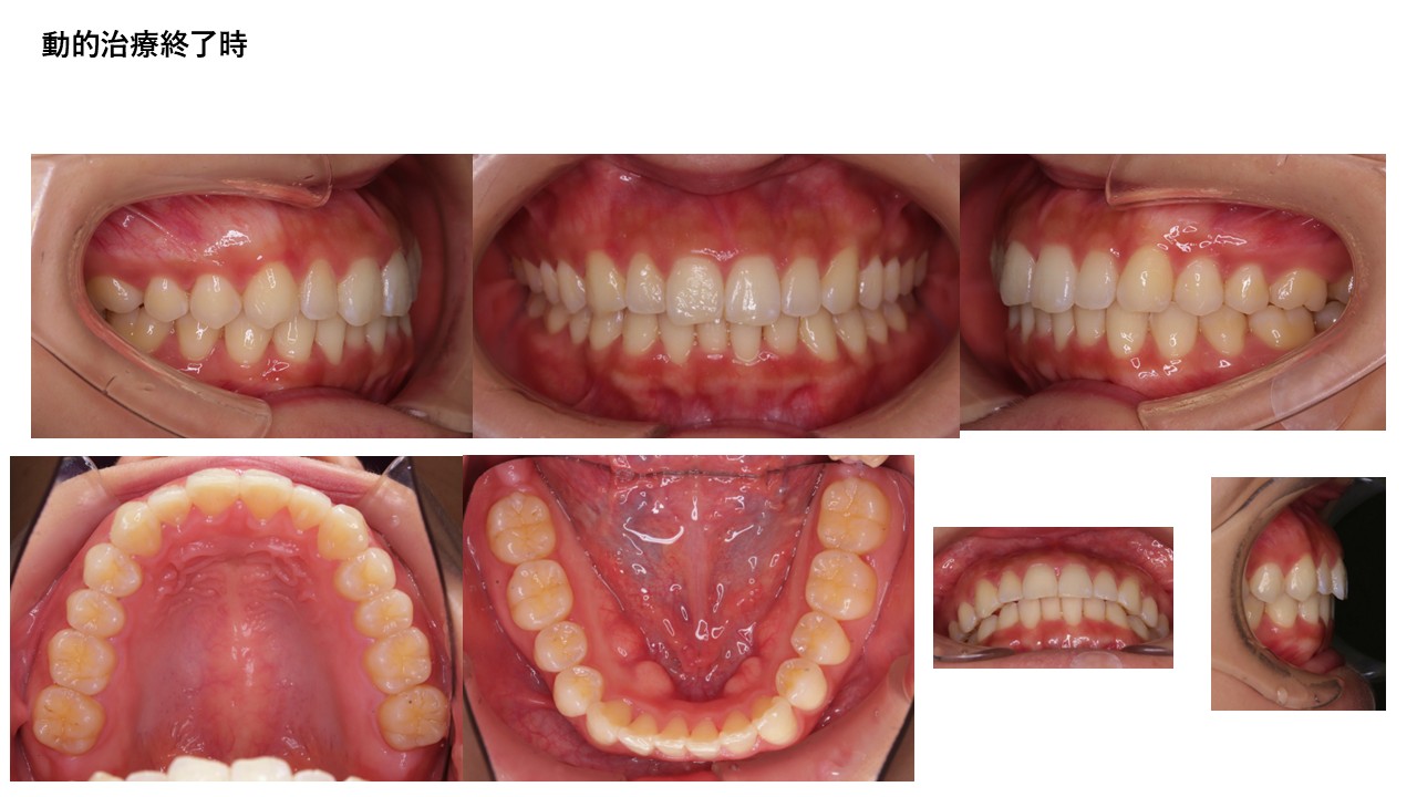 マウスピース矯正症例終了後