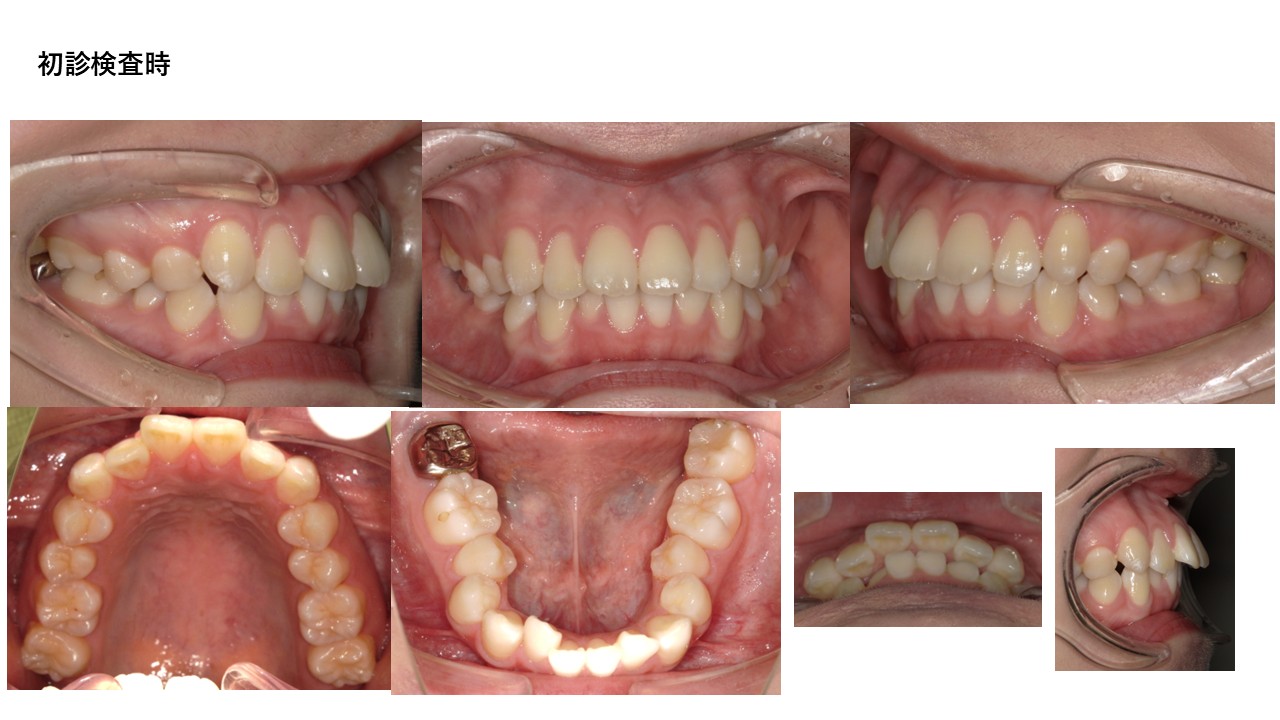 表側ワイヤー矯正症例初診時