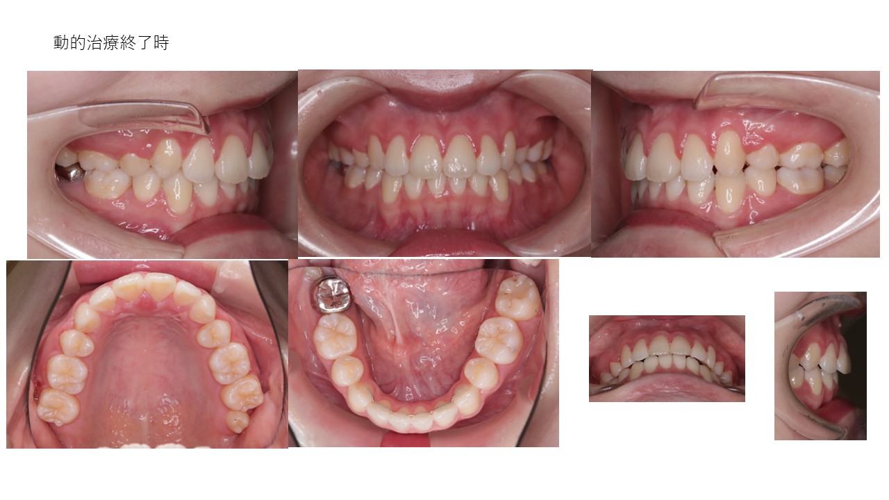 表側ワイヤー矯正症例終了後