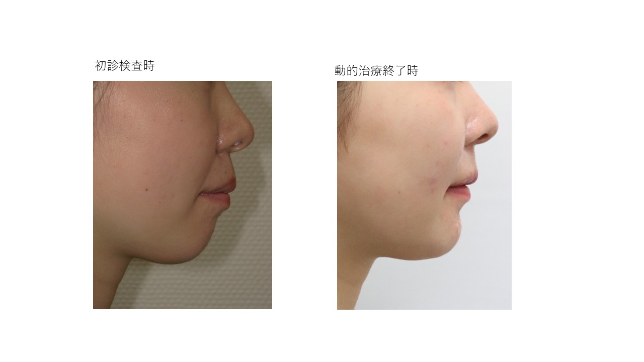 表側ワイヤー矯正症例終了後