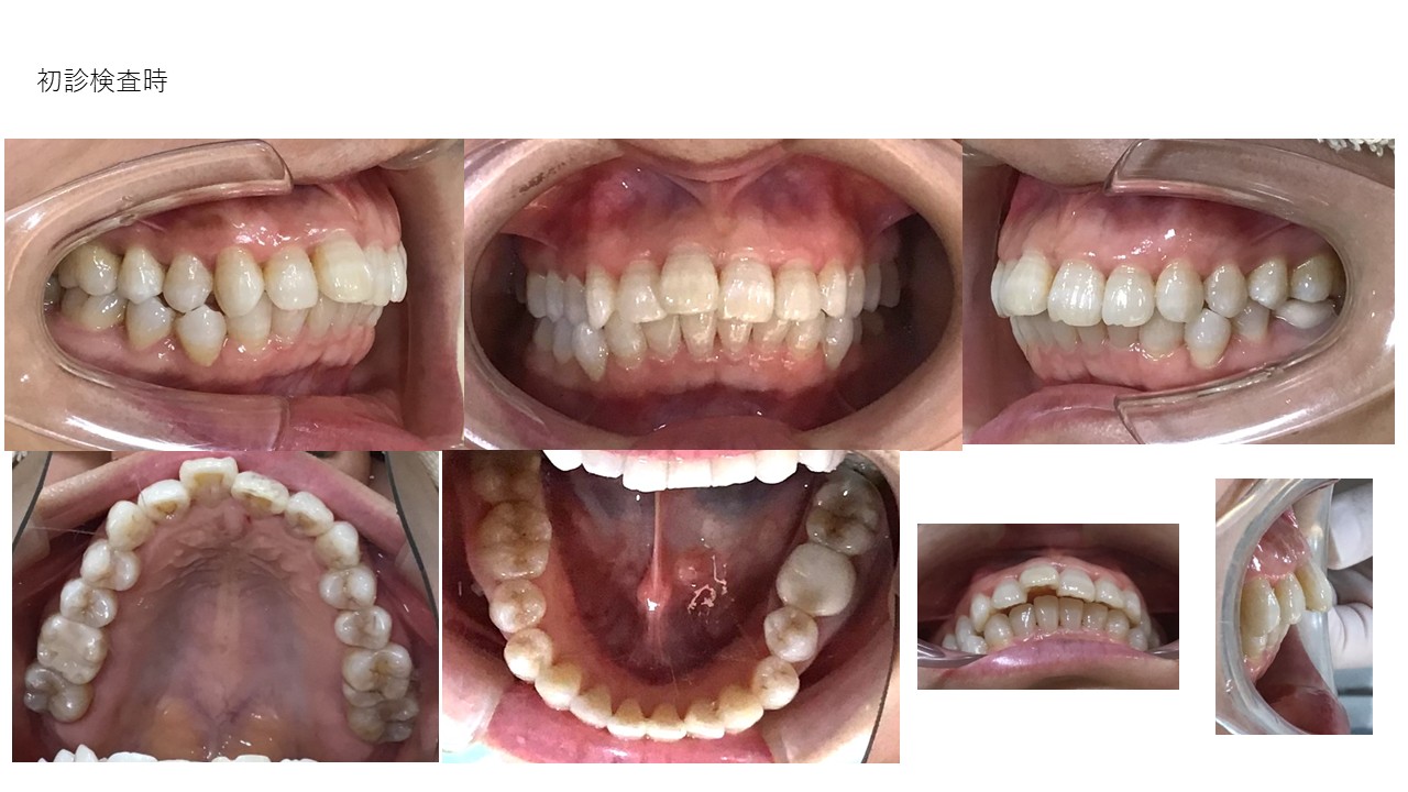 裏側ワイヤー矯正症例初診時