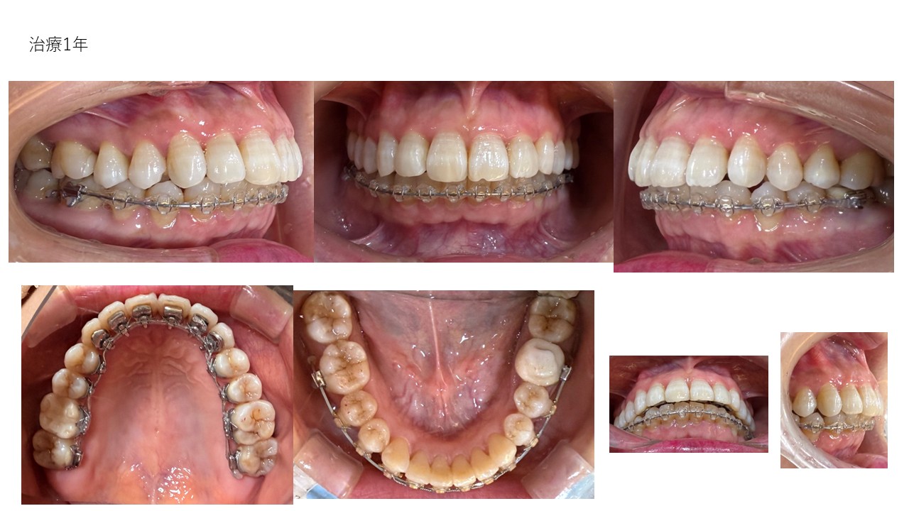 裏側ワイヤー矯正症例終了後